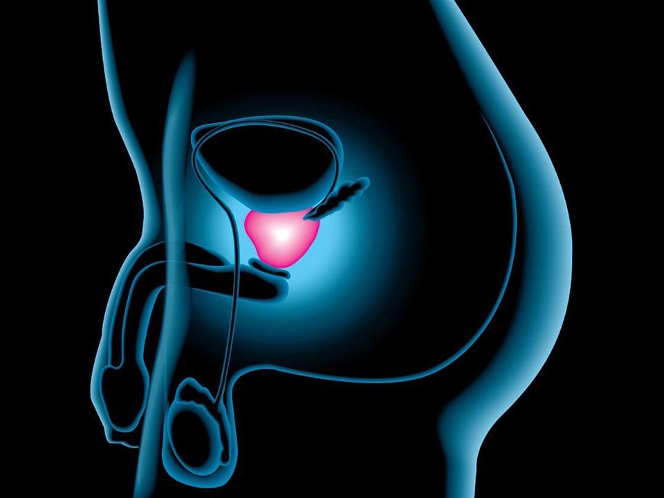 cancer de prostata