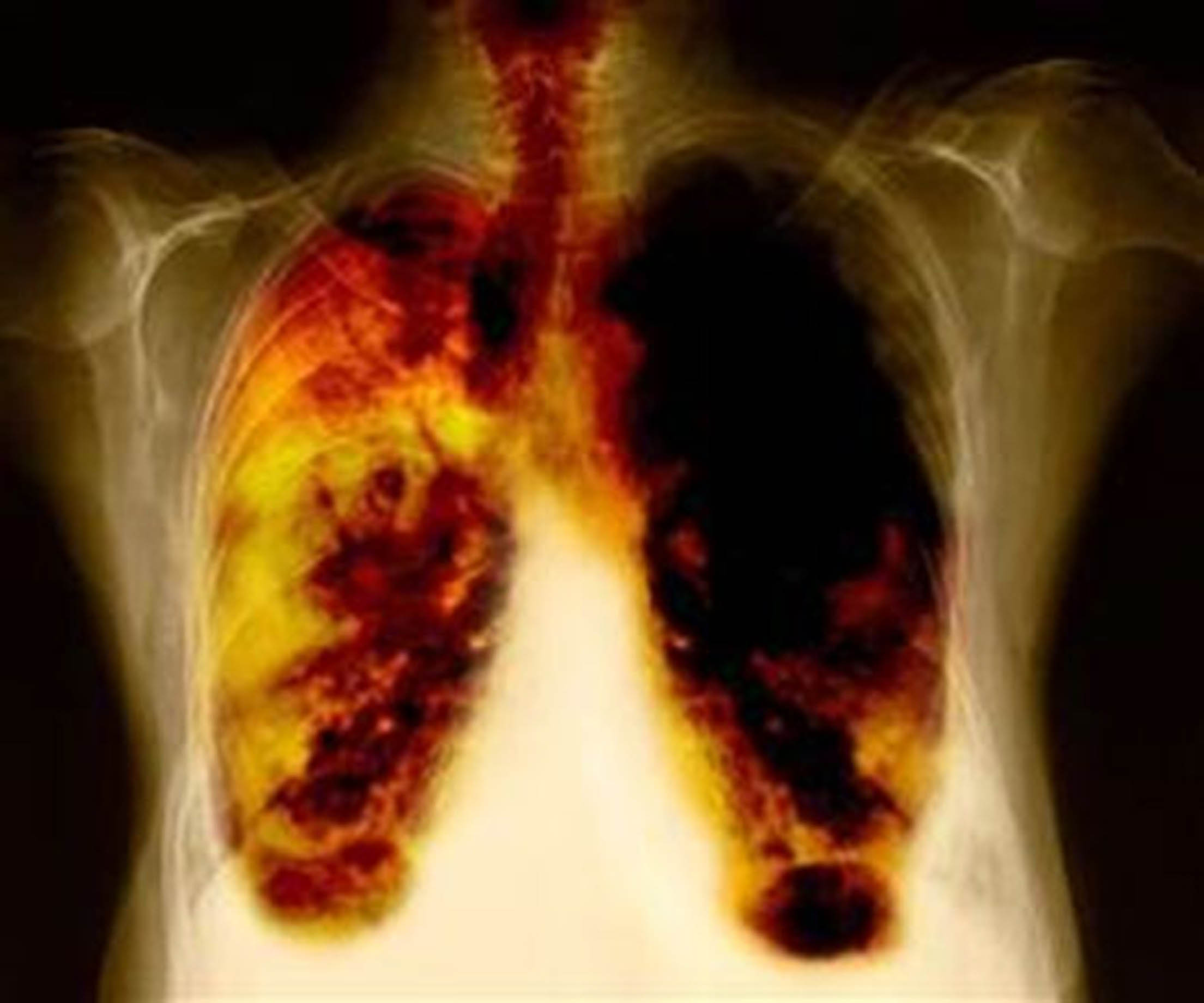 cancer-pulmonar