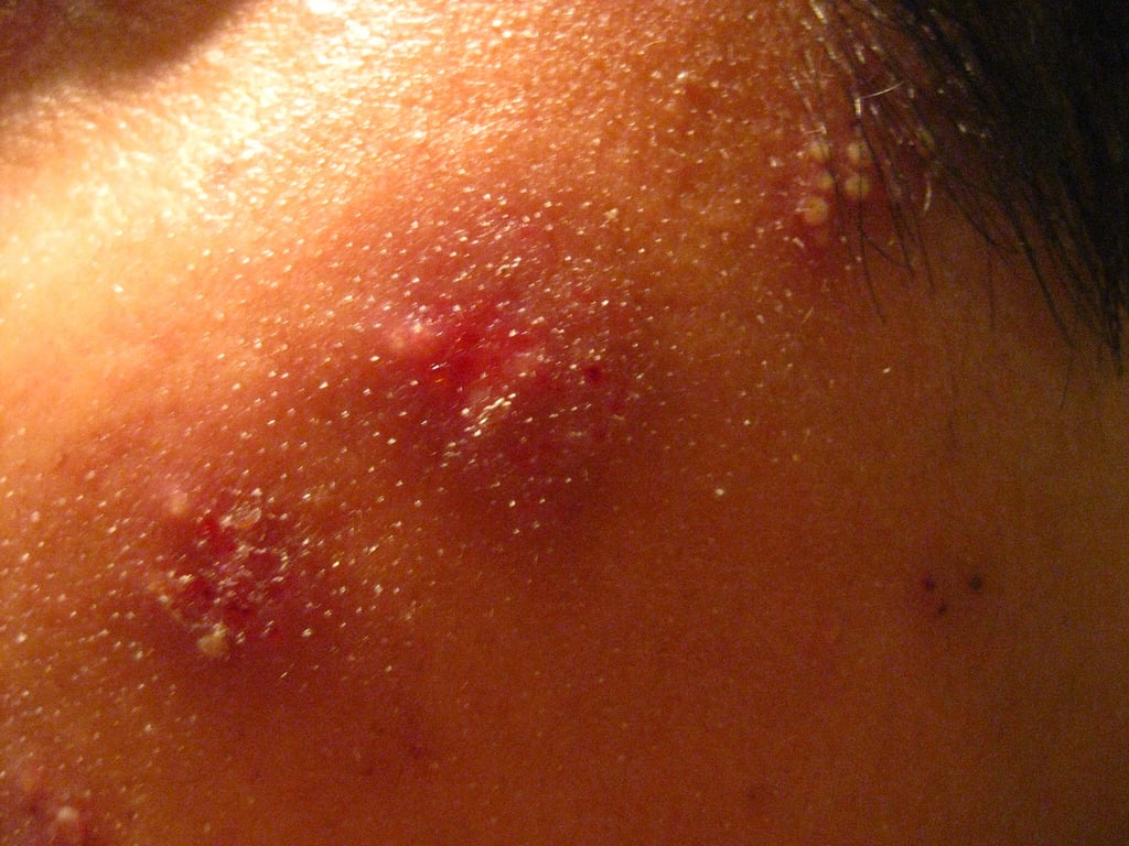 herpes-genital