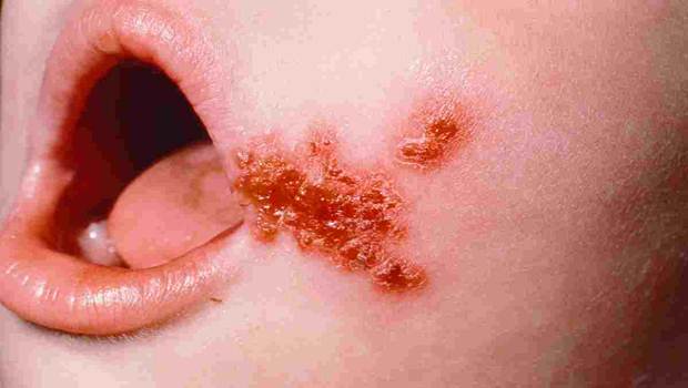 impetigo
