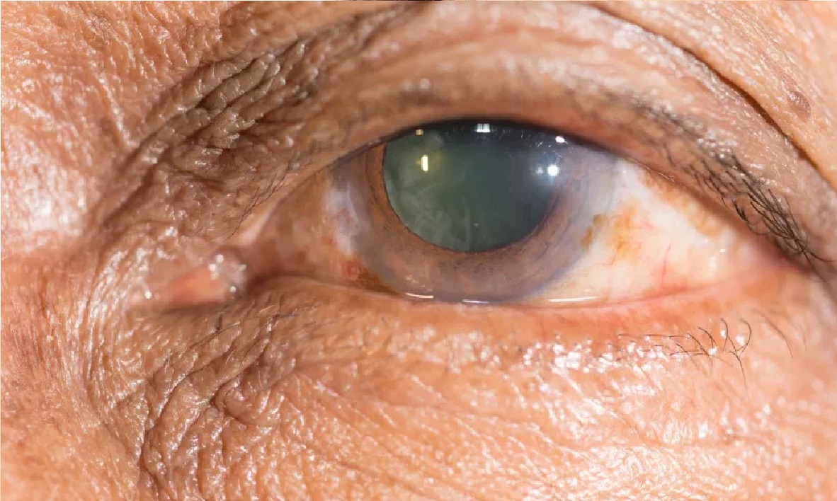 hierbas para curar cataratas ojos