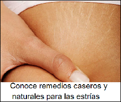 remedios para las estrías