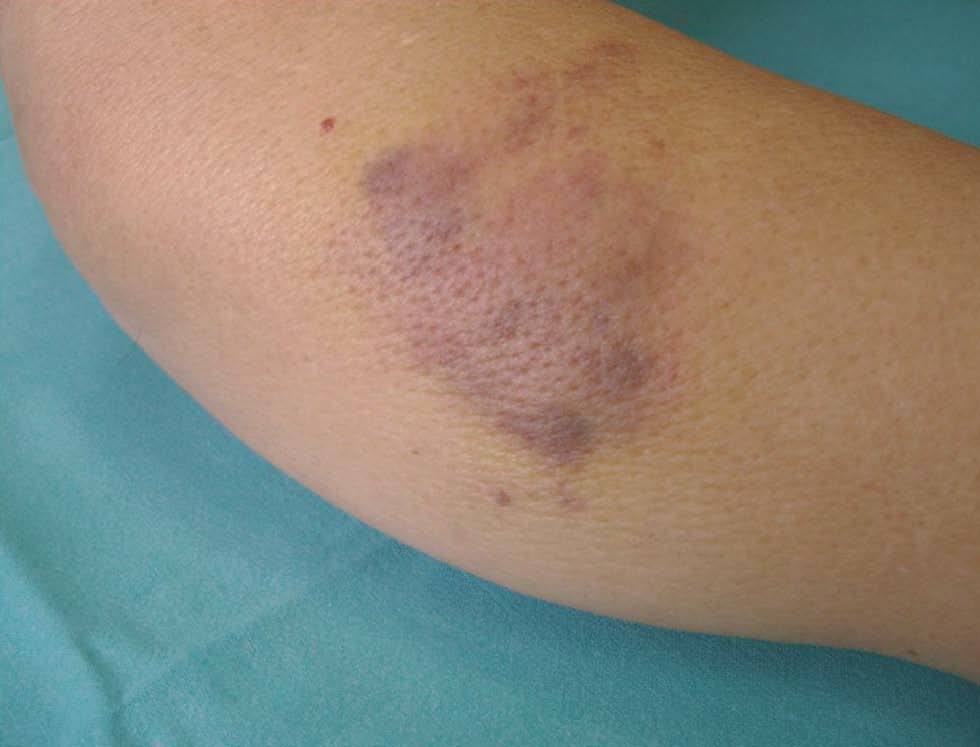 lesion por radioterapia