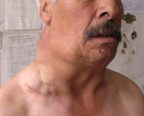remedios para el linfoma