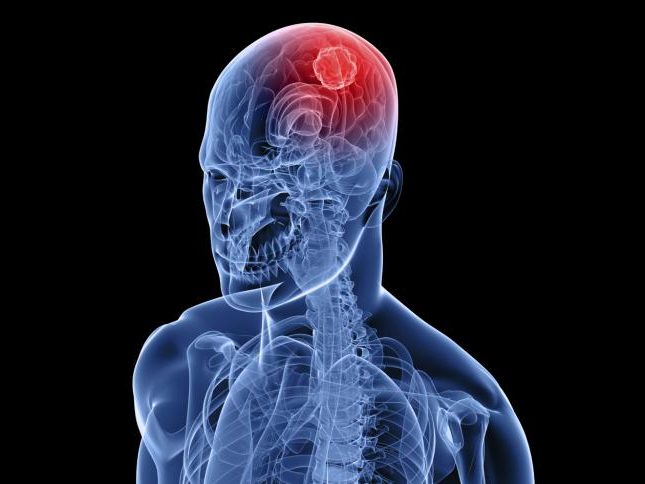 tumor cerebral