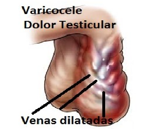 plantas medicinales para la varicocele
