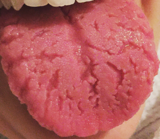 lengua con grietas