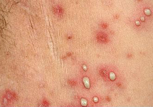 remedios acne pustuloso