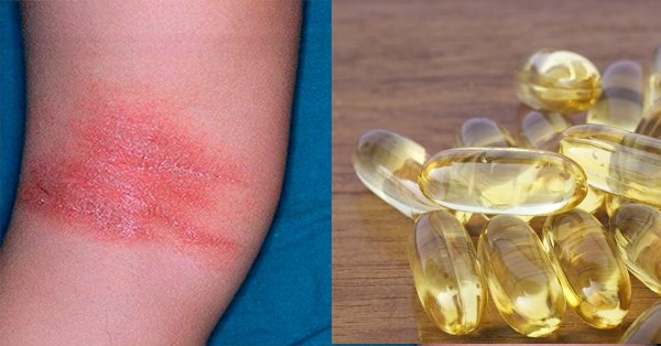 vitaminas y minerales para la dermatitis