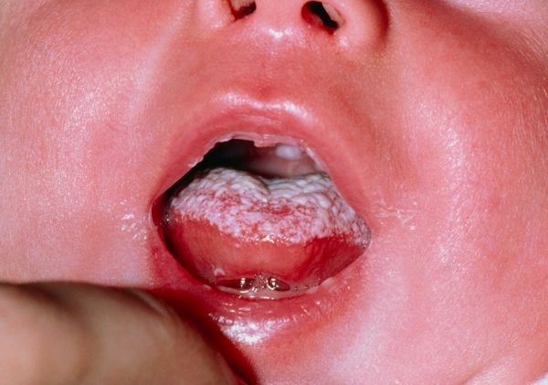 Remedios para la candidiasis en bebes