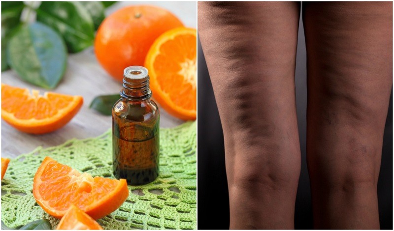 aceites esenciales para la celulitis