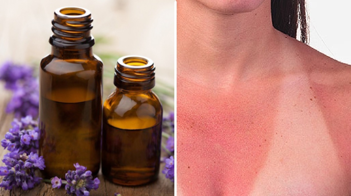 aceites esenciales quemaduras solares