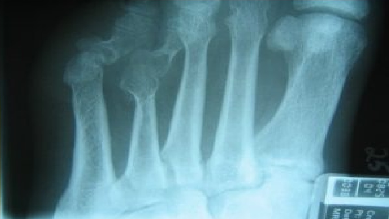 remedios para el dolor de huesos