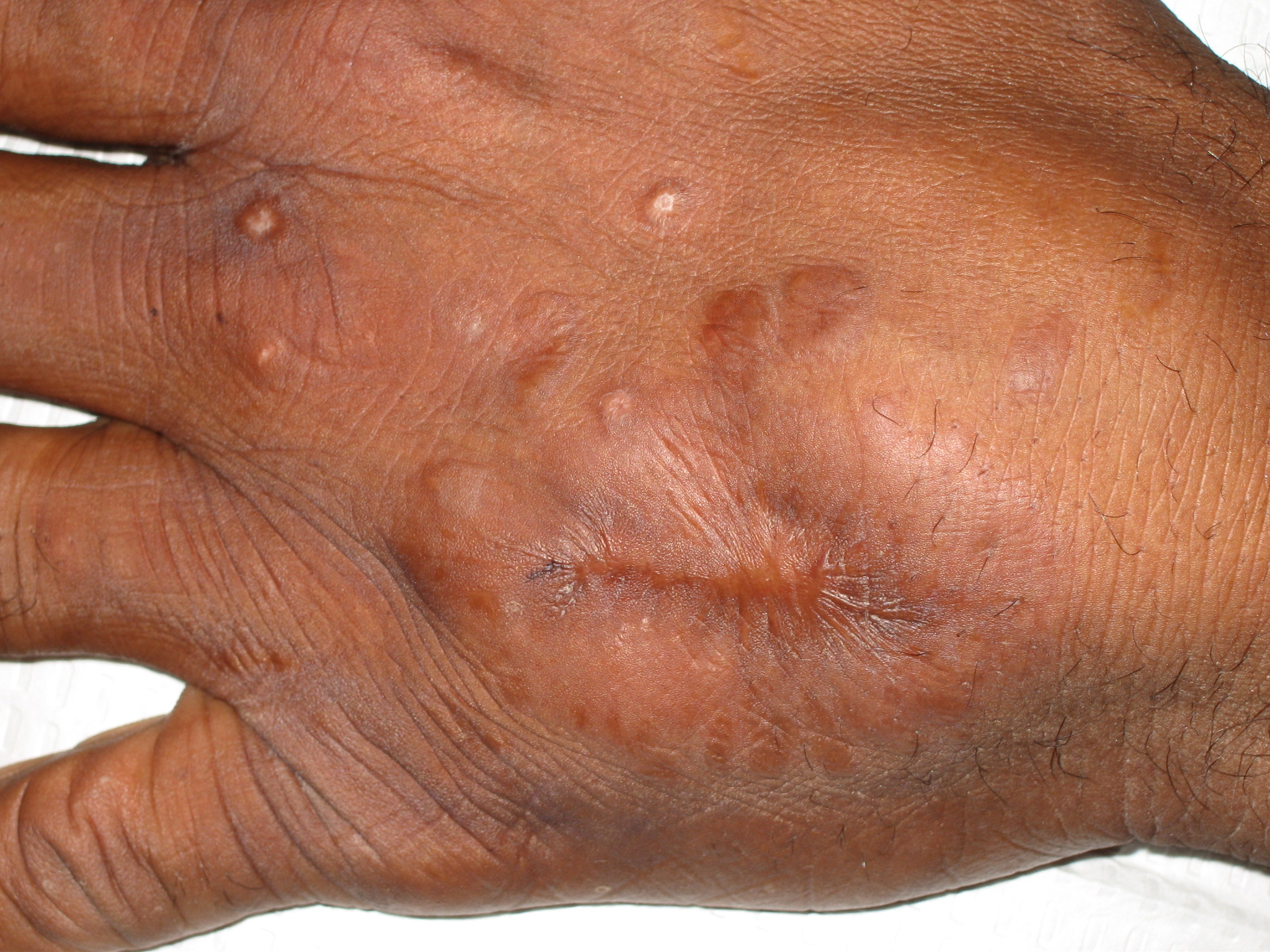 remedios sarcoidosis
