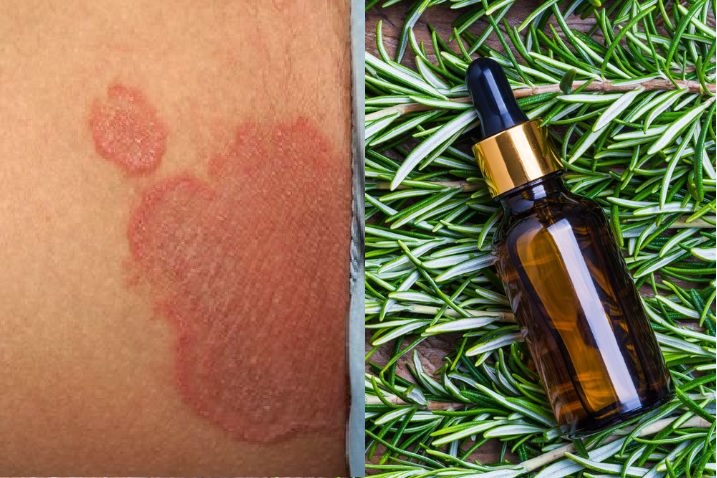 aceites esenciales para la tiña