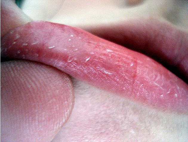 remedios para los labios agrietados